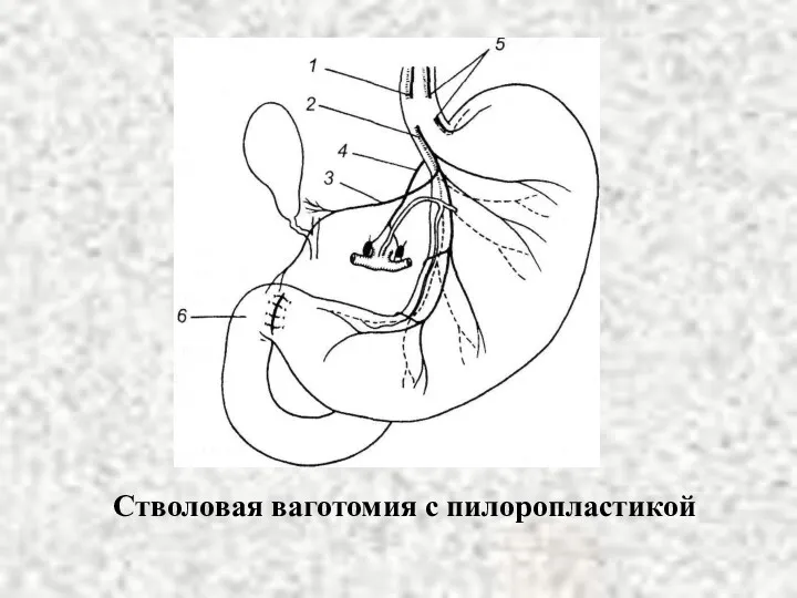 Стволовая ваготомия с пилоропластикой