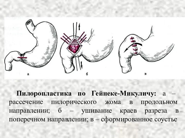 Пилоропластика по Гейнеке-Микуличу: а – рассечение пилорического жома в продольном