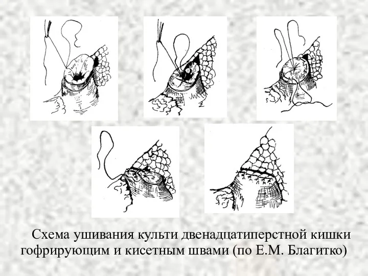 Схема ушивания культи двенадцатиперстной кишки гофрирующим и кисетным швами (по Е.М. Благитко)