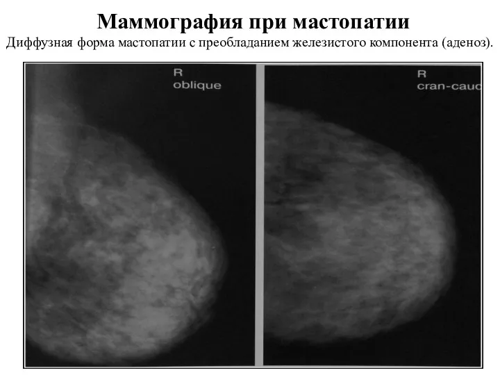Маммография при мастопатии Диффузная форма мастопатии с преобладанием железистого компонента (аденоз).