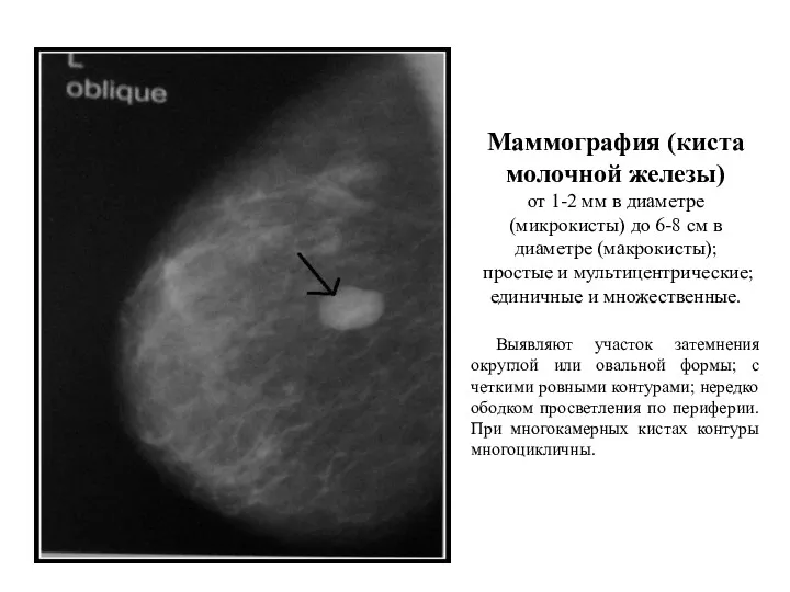 Маммография (киста молочной железы) от 1-2 мм в диаметре (микрокисты)