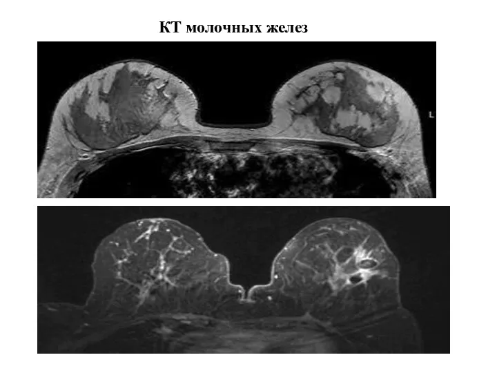 КТ молочных желез