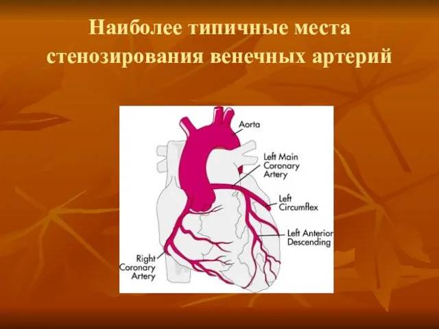 Наиболее типичные места стенозирования венечных артерий