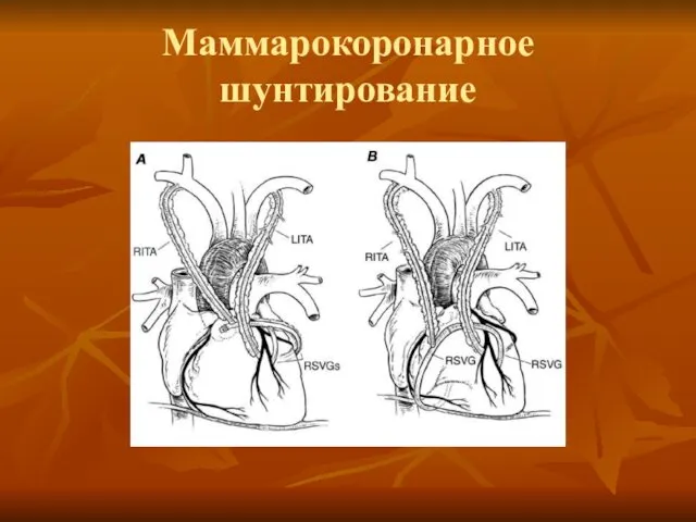 Маммарокоронарное шунтирование