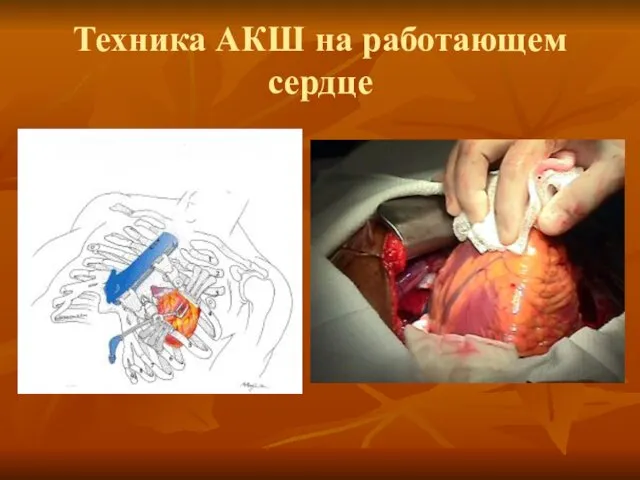 Техника АКШ на работающем сердце