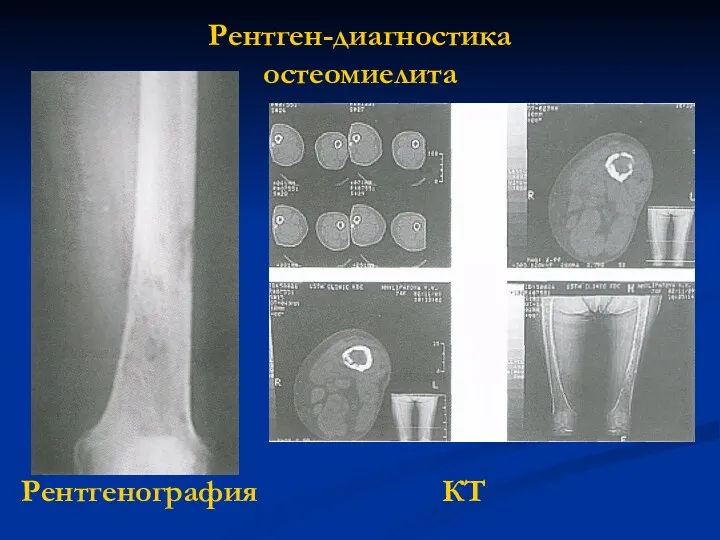 Рентген-диагностика остеомиелита Рентгенография КТ