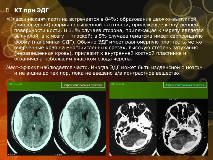 КТ при ЭДГ «Классическая» картина встречается в 84%: образование двояко-выпуклой