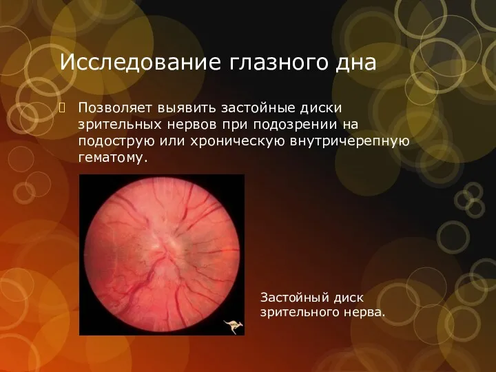 Исследование глазного дна Позволяет выявить застойные диски зрительных нервов при