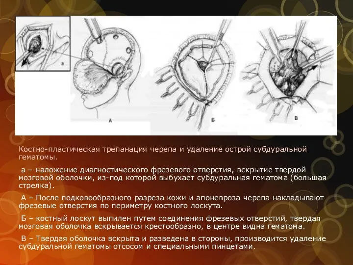 Костно-пластическая трепанация черепа и удаление острой субдуральной гематомы. а –