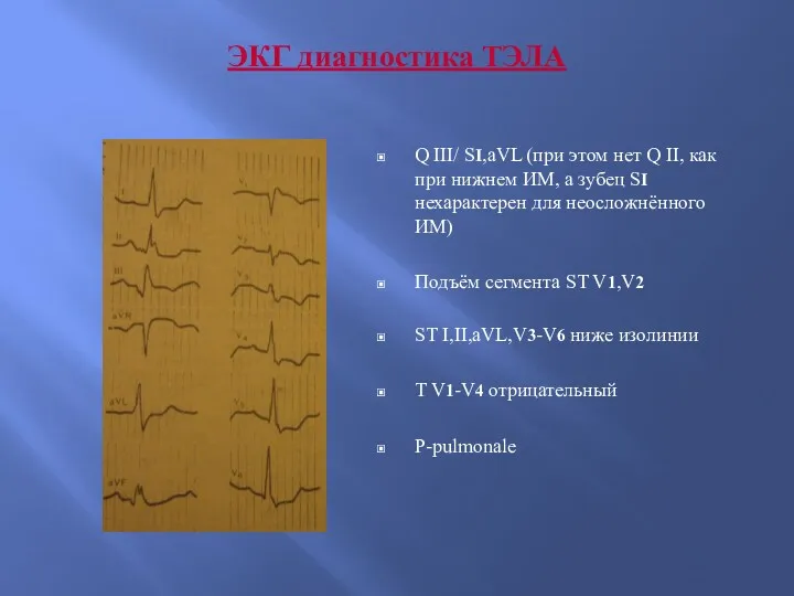 ЭКГ диагностика ТЭЛА Q III/ SI,aVL (при этом нет Q