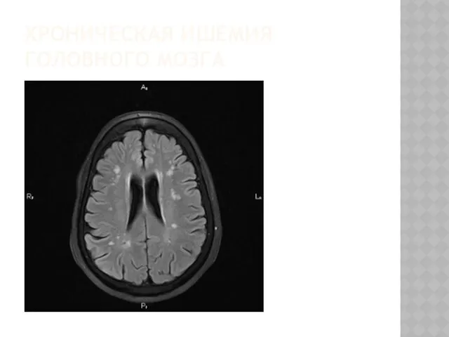 ХРОНИЧЕСКАЯ ИШЕМИЯ ГОЛОВНОГО МОЗГА