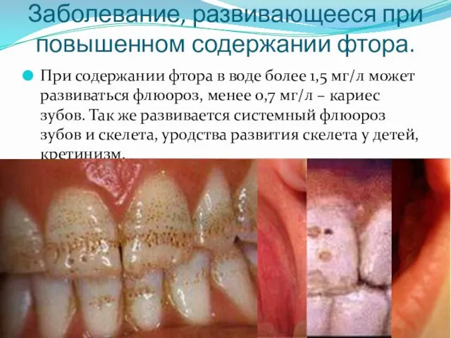 Заболевание, развивающееся при повышенном содержании фтора. При содержании фтора в