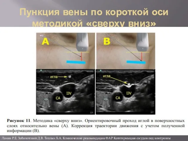 Пункция вены по короткой оси методикой «сверху вниз» Лахин Р.Е.