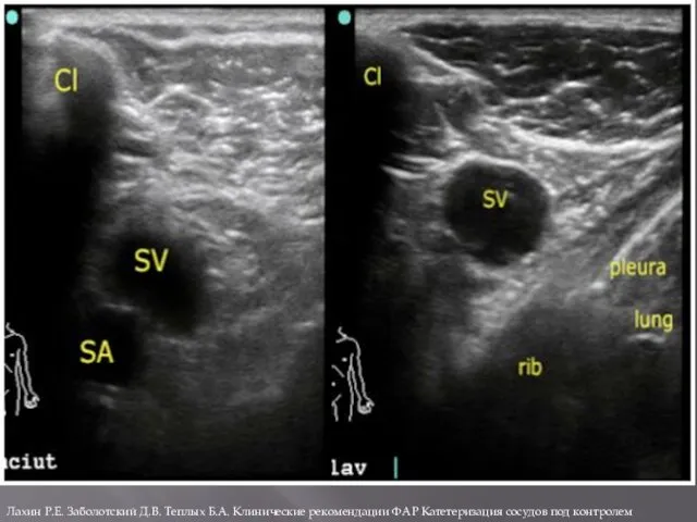 Лахин Р.Е. Заболотский Д.В. Теплых Б.А. Клинические рекомендации ФАР Катетеризация сосудов под контролем ультразвука