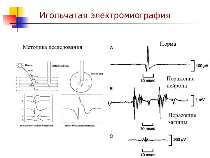 Игольчатая электромиография Методика исследования Норма Поражение нейрона Поражение мышцы