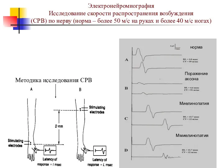 Электронейромиография Исследование скорости распространения возбуждения (СРВ) по нерву (норма –