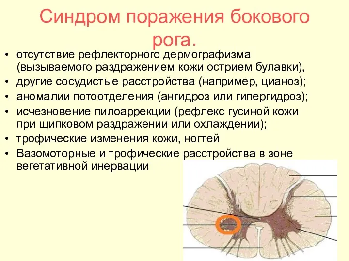 Синдром поражения бокового рога. отсутствие рефлекторного дермографизма (вызываемого раздражением кожи острием булавки), другие