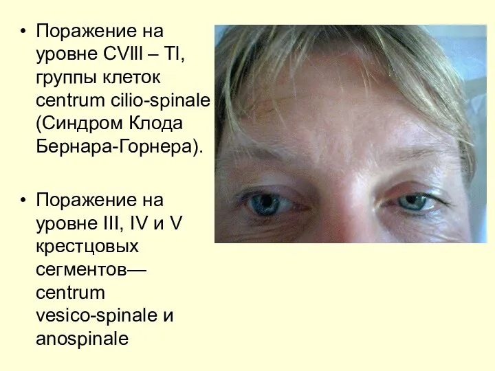 Поражение на уровне СVlll – Tl, группы клеток centrum cilio-spinale (Синдром Клода Бернара-Горнера).