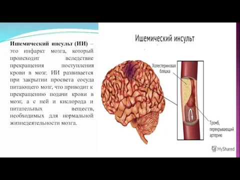 Ишемический инсульт (ИИ) – это инфаркт мозга, который происходит вследствие