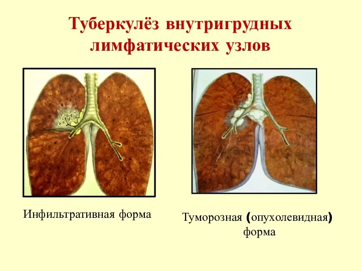 Туберкулёз внутригрудных лимфатических узлов Инфильтративная форма Туморозная (опухолевидная) форма