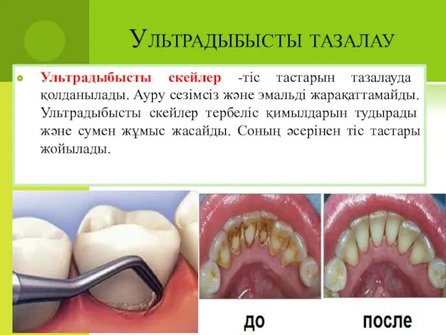 Ультрадыбысты тазалау Ультрадыбысты скейлер -тіс тастарын тазалауда қолданылады. Ауру сезімсіз