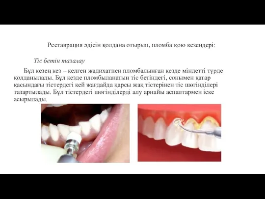 Реставрация әдісін қолдана отырып, пломба қою кезеңдері: Тіс бетін тазалау