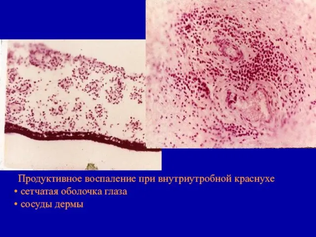 Продуктивное воспаление при внутриутробной краснухе сетчатая оболочка глаза сосуды дермы