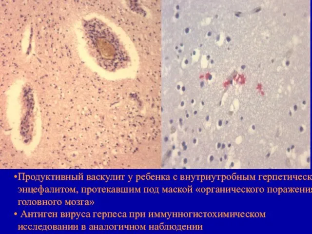 Продуктивный васкулит у ребенка с внутриутробным герпетическим энцефалитом, протекавшим под