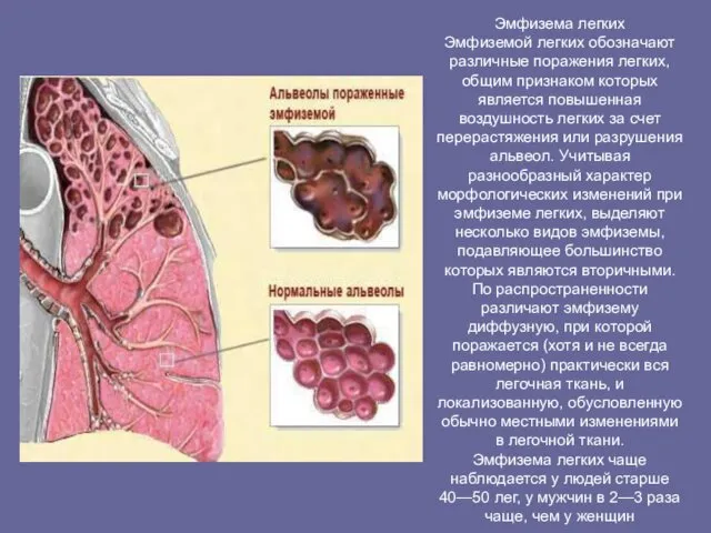Эмфизема легких Эмфиземой легких обозначают различные поражения легких, общим признаком