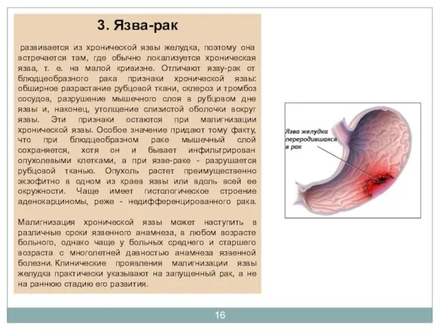 3. Язва-рак развивается из хронической язвы желудка, поэтому она встречается