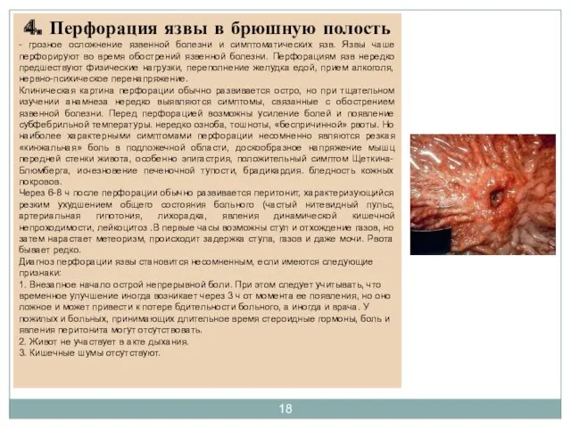 4. Перфорация язвы в брюшную полость - грозное осложнение язвенной