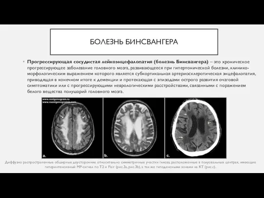 БОЛЕЗНЬ БИНСВАНГЕРА Прогрессирующая сосудистая лейкоэнцефалопатия (болезнь Бинсвангера) – это хроническое