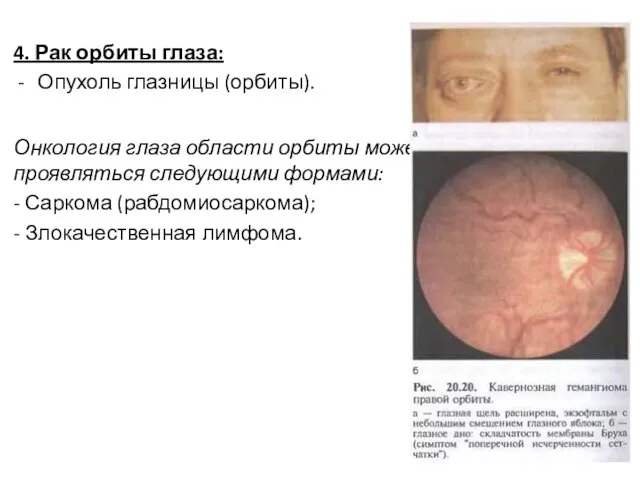 4. Рак орбиты глаза: Опухоль глазницы (орбиты). Онкология глаза области
