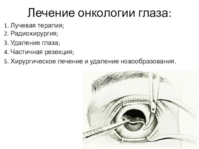 Лечение онкологии глаза: 1. Лучевая терапия; 2. Радиохирургия; 3. Удаление