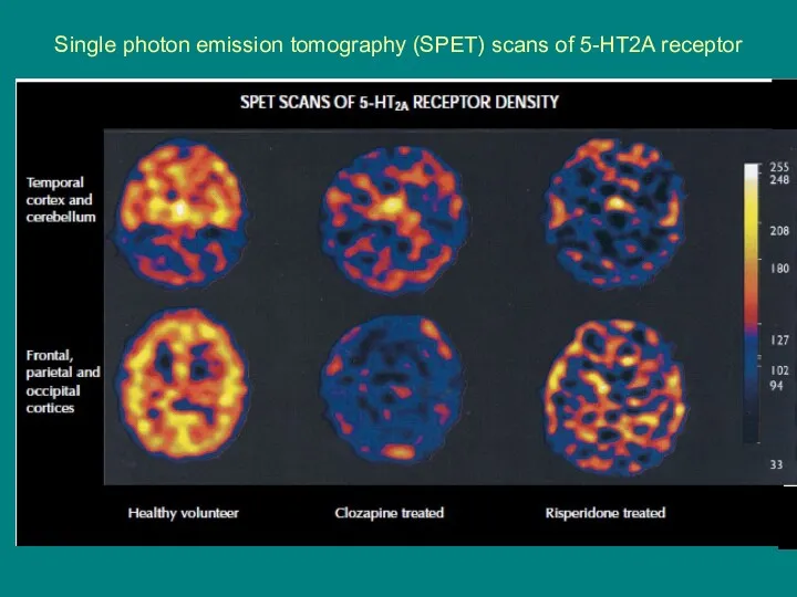Single photon emission tomography (SPET) scans of 5-HT2A receptor