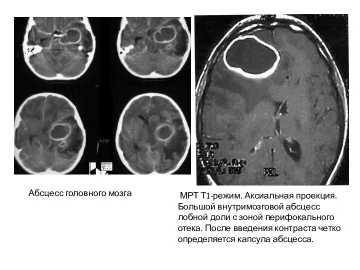 Абсцесс головного мозга МРТ Т1-режим. Аксиальная проекция. Большой внутримозговой абсцесс