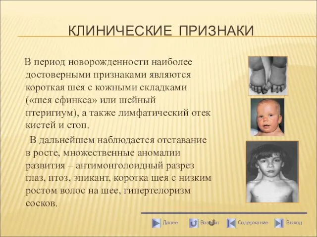 КЛИНИЧЕСКИЕ ПРИЗНАКИ В период новорожденности наиболее достоверными признаками являются короткая шея с кожными