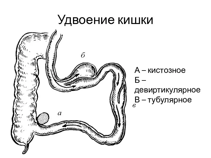 Удвоение кишки А – кистозное Б – девиртикулярное В – тубулярное