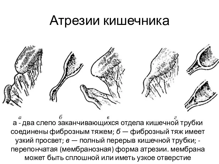 Атрезии кишечника а - два слепо заканчивающихся отдела кишечной трубки соединены фиброзным тяжем;