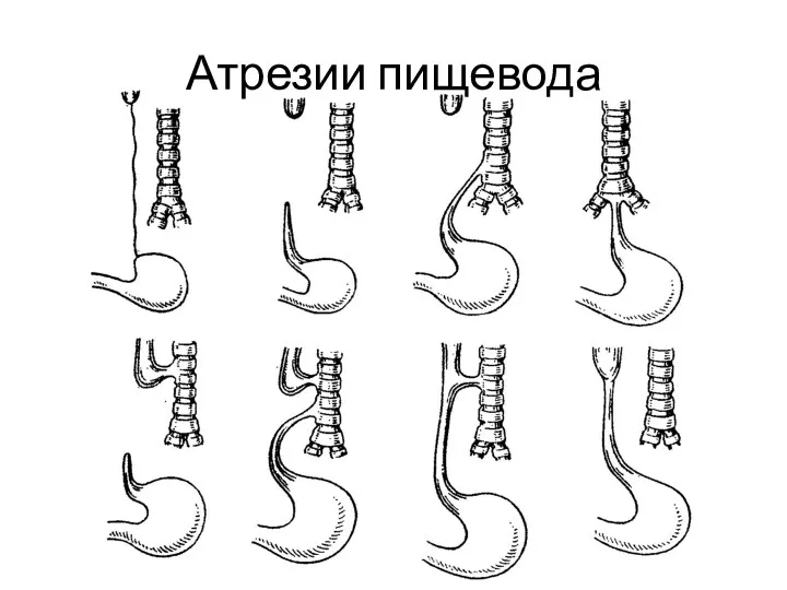 Атрезии пищевода