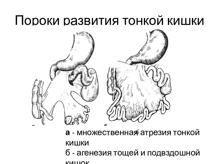 Пороки развития тонкой кишки а - множественная атрезия тонкой кишки б - агенезия