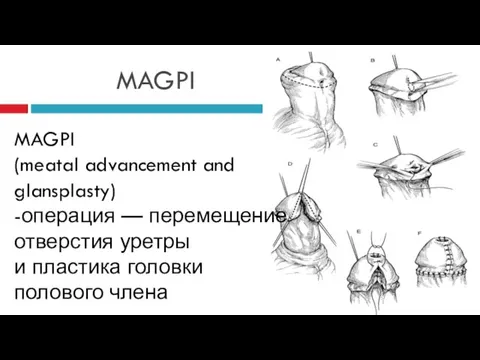 MAGPI MAGPI (meatal advancement and glansplasty) -операция — перемещение отверстия уретры и пластика головки полового члена