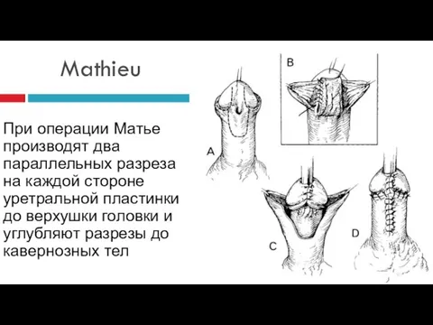 Mathieu При операции Матье производят два параллельных разреза на каждой