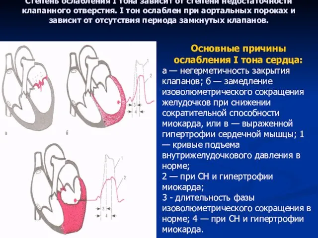 Степень ослабления I тона зависит от степени недостаточности клапанного отверстия.