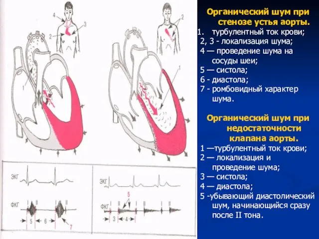 Органический шум при стенозе устья аорты. турбулентный ток крови; 2,