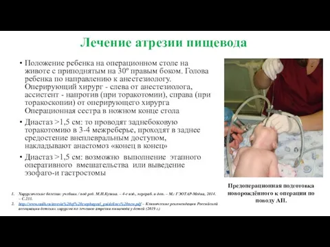 Лечение атрезии пищевода Положение ребенка на операционном столе на животе с приподнятым на
