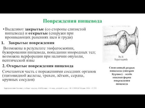 Повреждения пищевода Выделяют закрытые (со стороны слизистой пищевода) и открытые (снаружи при проникающих