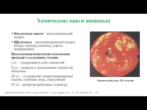 Химические ожоги пищевода Кислотные ожоги – коагуляционный некроз Щёлочные –