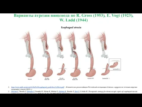 Варианты атрезии пищевода по R. Gross (1953), E. Vogt (1923), W. Ladd (1944)
