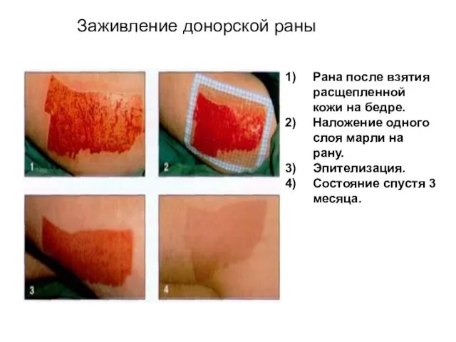 Заживление донорской раны Рана после взятия расщепленной кожи на бедре. Наложение одного слоя